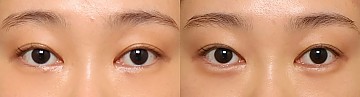 애교필러 썸네일