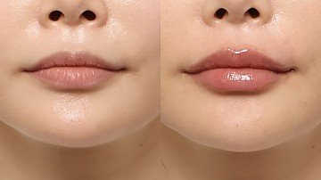 입술필러 썸네일