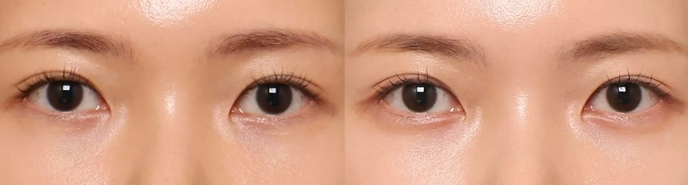 애교필러 정면 전후사진