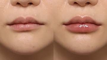 입술필러 썸네일