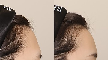 이마필러 5cc 썸네일