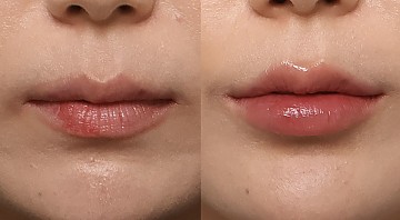 입술필러 썸네일