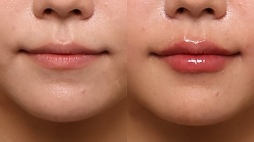 입술필러 썸네일