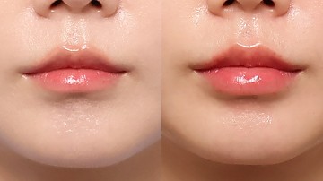 입술필러 썸네일