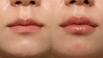 입술필러 썸네일
