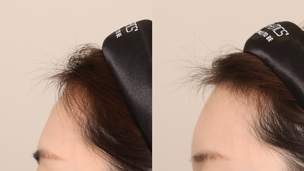 이마필러 4cc 측면 전후사진