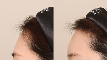 이마필러 4cc 썸네일