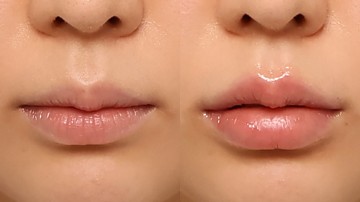 입술필러 썸네일