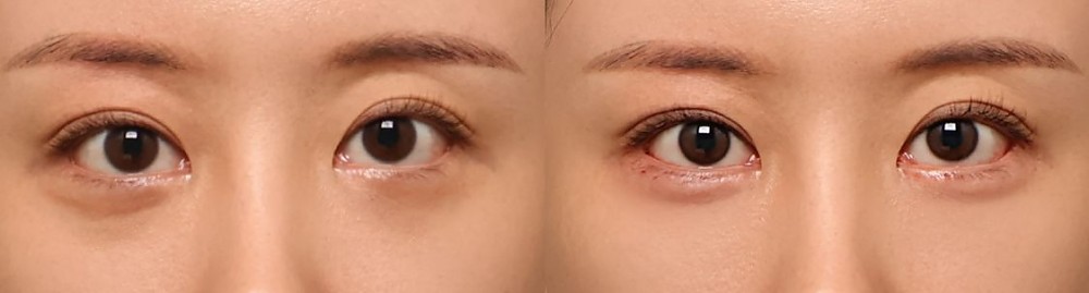 애교필러 정면 전후사진