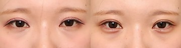 애교필러 썸네일
