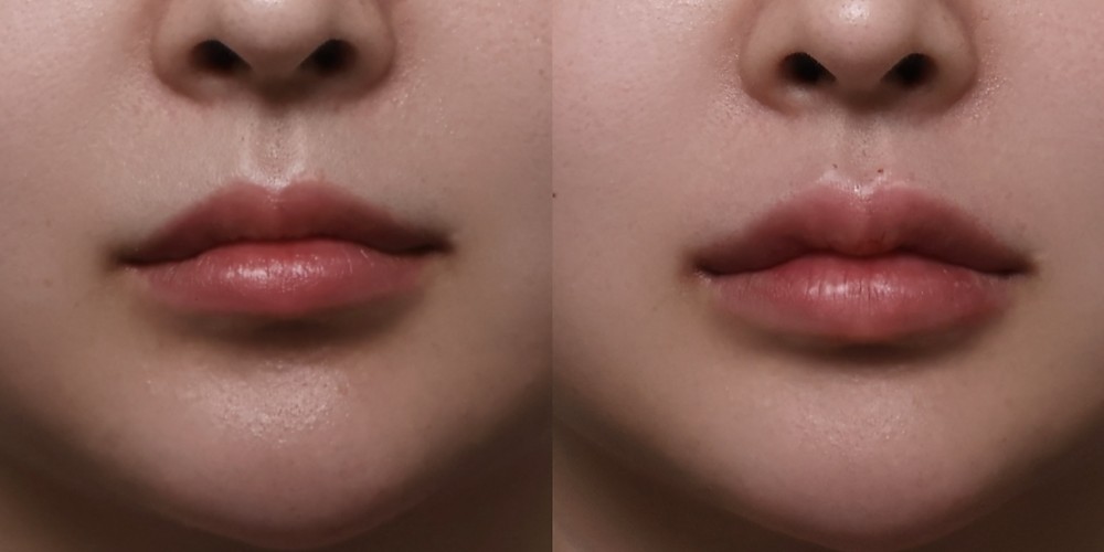 입술필러 정면 전후사진