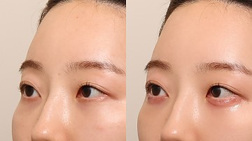 애교필러 썸네일