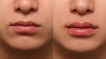 남자 입술필러 썸네일