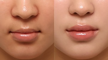 입술필러 썸네일