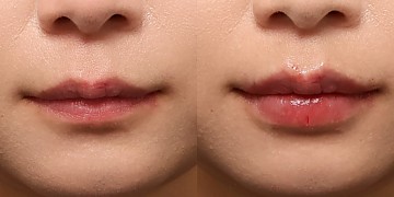 입술필러 썸네일
