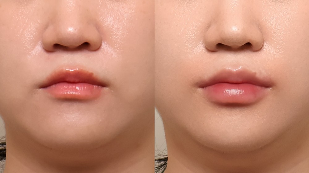 입술필러 정면 전후사진