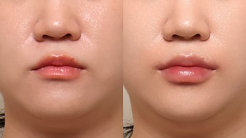 입술필러 썸네일