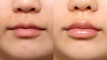 입술필러 썸네일