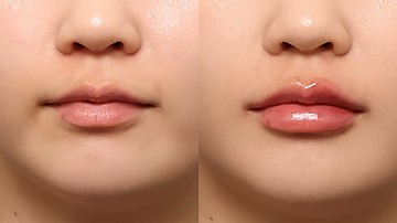 입술필러 썸네일