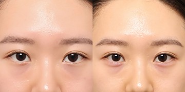 애교필러 썸네일