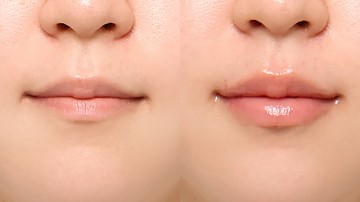 입술필러 썸네일