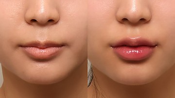 입술필러 썸네일